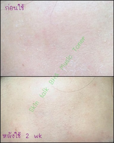 ก่อนใช้ vs หลังใช้-edit