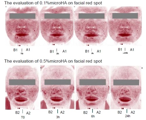 ลดรอยแดง